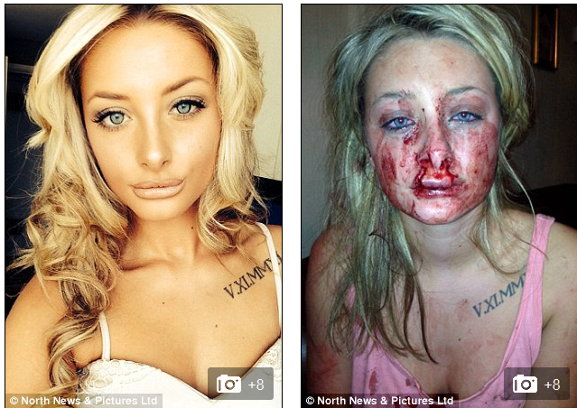 Rhys_Culley_BIT_girlfriend_Chanttelle_Ward_s_lip_in_bid_to_disfigure_her_Mail_Online_-_2014-09-06_12.26.35